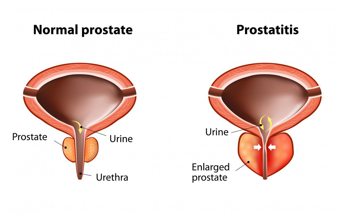 Egészséges férfi normál prosztata és prosztatagyulladás prosztatagyulladással