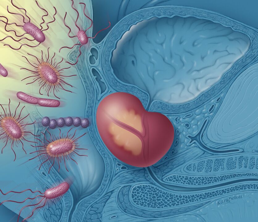 Prostatitis férfiakban