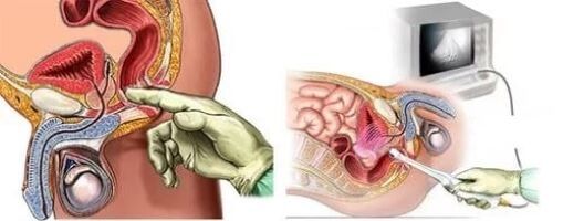 A prosztatitisz instrumentális diagnosztizálása
